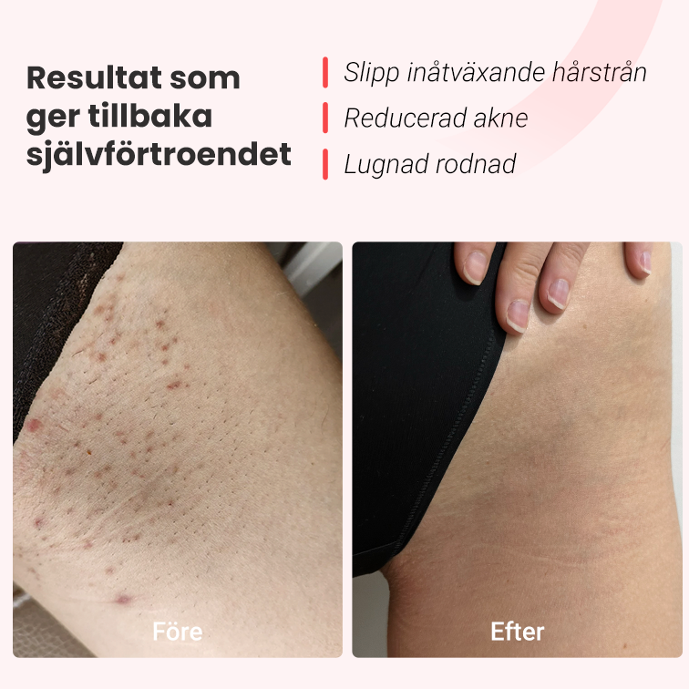 IPL Hårborttagare